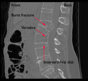 Fractures of the Thoracic and Lumbar Spine (part 2)