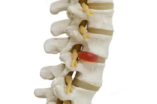 Close-up view of herniated lumbar vertebral disc model