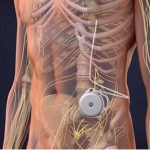 Understanding the Intrathecal Spinal Pump Implant